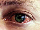 طبيب عيون توضح أسباب النزيف داخل العين