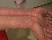 ما هو مرض جلد السمكة؟