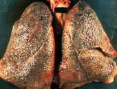 تليف الرئة مرض منتشر وأعراضه تتمثل فى ضيق فى التنفس وكحة بدون بلغم