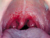 ما سبب الإصابة بسرطان الحلق؟