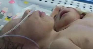 سيدة تلد طفلاً برأسين وقلبين فى المنوفية بعد تأخر إنجاب لمدة 5 سنوات