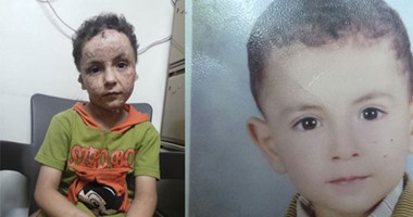 بالصور.. مأساة طفل "وسيم" حوله حريق منزله إلى "شبح" مبتور الأصابع.. عبد الرحمن "البرىء" رفضته المدرسه "لأن شكله هيخوف زمايله".. والأم: بعد 13 عملية ابنى يحتاج لجراحة كبرى بالخارج و"ما باليد حيلة"
