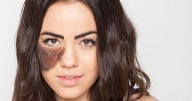 لو مضايقاكى.. 5 طرق طبيعية للتخلص من وحمة الجلد