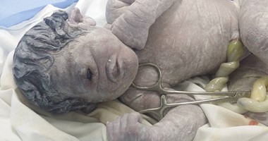 بالصور.. تفاصيل ولادة طفل بـ"عين واحدة" فى الدقهلية.. الطبيب: الحالة رقم 6 على مستوى العالم خلال 5 قرون.. وُلِدَ بدون أنف أو فتحة شرج.. يعانى من خلل جنينى ووفاته بعد ساعتين لاستحالة استمراره فى الحياة