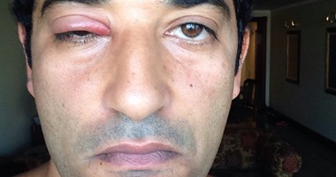 عمرو سعد ينشر صورته وهو مصاب بفيلم "حديد" على صفحته بـ"فيس بوك"