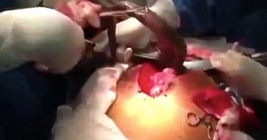 بالفيديو.. استخراج سمكة حية بطول 1متر من أمعاء رجل برازيلى