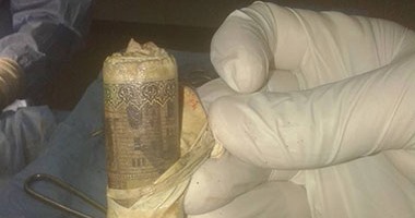 بالصور.. جراح بأسيوط يخرج 1000 جنيه من أحشاء مريض أثناء عملية الزائدة