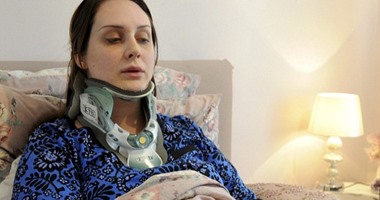 ضعف بروتين الكولاجين المسئول عن العظام يعرض فتاة لغرق رقبتها فى جسدها