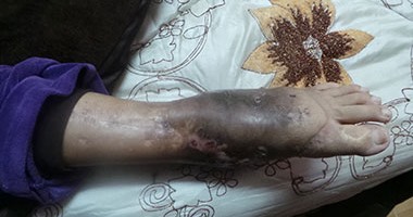 إخلاء سبيل طبيبة بكفالة 3 آلاف جنيه بتهمة الإهمال والتسبب فى بتر قدم طفل