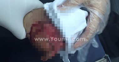 بالصور.. تطاير أجزاء من يد شاب أثناء إشعاله ألعاب نارية بالمنصورة