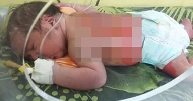 القومى لمكافحة الفساد يشيد بإغلاق الصحة للمستشفى المتسبب فى حرق طفل بالحضانة