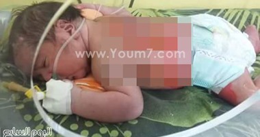 "رئاسة الوزراء" تتبنى علاج رضيع احترق نتيجة إهمال مستشفى خاص بالإسكندرية