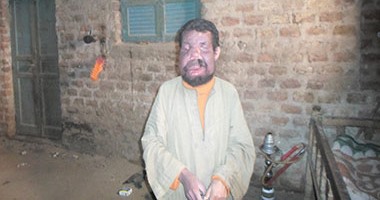 بالصور.. مأساة شاب بسوهاج ولد بمرض نادر عجز الأطباء عن تشخيصه.. "خالد" يطالب المسئولين بعلاجه على نفقة الدولة وتوفير فرصة عمل.. والده:نجلى يعانى من تورم فى وجهه منذ ولادته ولم أجد علاجا له بالمستشفيات