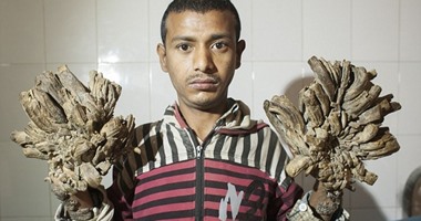 بالصور...ظهور رجل بأطراف على شكل شجرة فى بنجلاديش