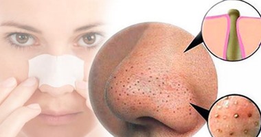 علاج البثور السوداء بالطرق الطبيعية