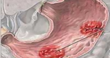 لو عندك قرحة معدة.. اعرف الأطعمة المفيدة والضارة 
