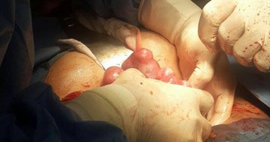 بالصور.. جراحة نادرة لاستئصال 22 "ورم ليفى" بالرحم لسيدة تبلغ 28 عامًا