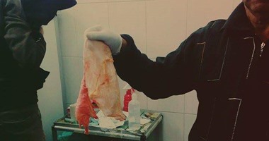 صحافة المواطن: بالصور.. أطباء يتركون "فوطة" داخل ساق مواطن لمدة شهر