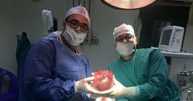 بالصور.. استئصال ورم نادر وزنه كيلو وربع لطفل بالمنصورة