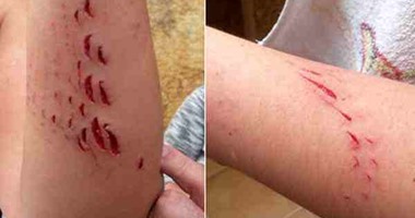 لأول مرة منذ 50 عاما.. سمكة قرش تهاجم امرأة على الشواطىء الإسبانية