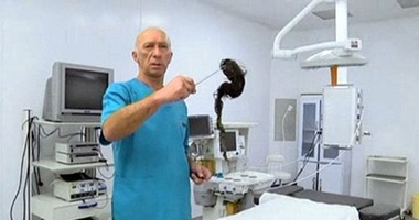 بالفيديو..استخراج كيلو شعر من معدة فتاة بريطانية تأكله يوميا بسبب مرض نادر