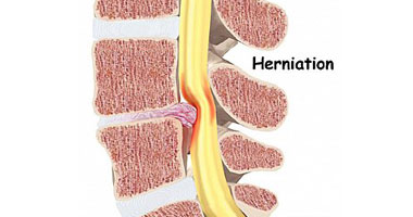 أمراض العظام.. 6 طرق لعلاج وتغذية الغضروف