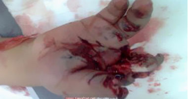 فقد أصبعه بسبب معاكسته لفتاة فى كفر الشيخ