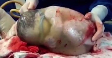 بالفيديو.. طفل إسبانى يولد من بطن أمه داخل "غشاء أمينوسى"