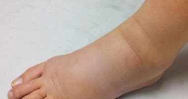 أعراض احتباس السوائل فى الجسم