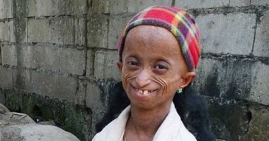 وفاة "الفتاة العجوز" فى الفلبين.. بدت وكأنها 150 عاما فى سن الـ19