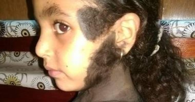 بالصور.. مأساة طفلة مصابة بمرض نادر.. الأب: ببيع بطاطا ومش معايا أعالج بنتى والأطباء قالولى تحتاج جلستين شهرياً بـ3 آلاف جنيه.. الأم: الأطفال بيسخروا من بنتى.. وعلاجها على نفقة الدولة أبرز مطالبهم