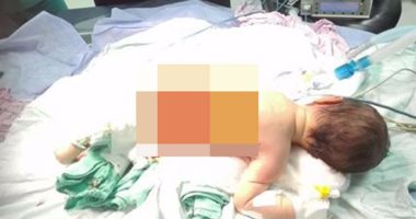 إجراء جراحة لاستئصال "قيلة عصبية" لطفلة بعد 5 أيام من ولادتها بدمياط