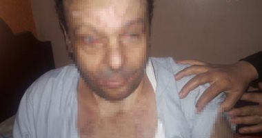بالصور.. مأساة مواطن حرقه شقيقه بـ"ماء النار" يطالب بتسهيل علاجه بالخارج