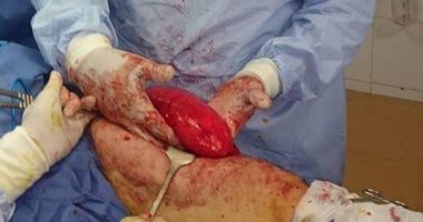 أطباء الشرقية ينجحون فى استئصال ورم وزنه 1.5 كيلو من قدم مريضة