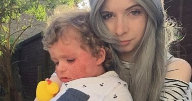 بالصور.. طفل يصاب بإكزيما جلدية وراثية تجعله ينزف دما من وجهه