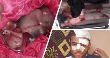 بالصور.. الإهمال يتسبب فى وفاة توأم بالدقهلية.. خطأ طبيب لإجهاض سيدة حامل بتوأم فى الشهر الخامس.. والنوم يمنعه من إصلاح الخطأ..الطبيب والتمريض يعتدون على السيدة وأقاربها ويصيبونهما بإصابات مختلفة