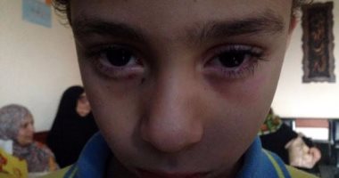 تفاصيل إصابة تلميذ لزميله بشرخ فى القرنية داخل مدرسة خاصة بالقليوبية