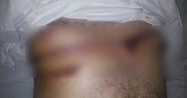 بالصور.. مستشفى الأحرار بالزقازيق ينقذ حياة شاب بعد شق صدره نصفين