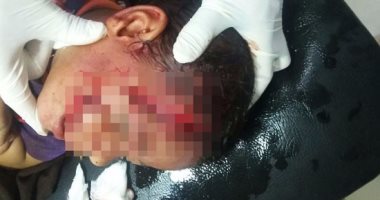 بالصور .. كلاب ضالة تعقر  شخصين وطفلة بكفر الشيخ 