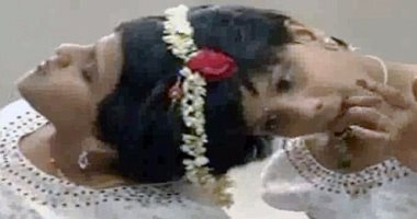 بالصور.. توأم ملتصق من الرأس يستعد للفصل بعد 14 عاما بالهند