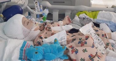 فصل توأم ملتصق من الرأس بعد 20 ساعة فى غرفة العمليات 