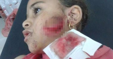 استياء أهالى بنى عبيد بالدقهلية بعد عقر كلب ضال 4 أشخاص