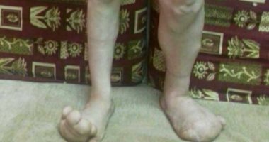 الطفل أحمد يعانى من مرض نادر ويحتاج لعملية بتر للقدمين