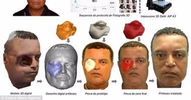 بالصور..ناجٍ من السرطان يستخدم تقنية 3D لسد فجوة تركها الورم فى وجهه