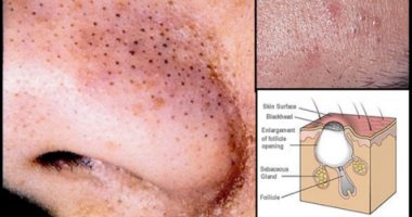 4 طرق صحية للتخلص من البثور السوداء فى الأنف