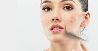 خطوات للحفاظ على بشرتك عند استخدام كريمات حب الشباب