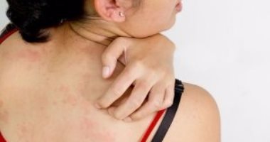 تعرف ايه عن الكانديدا.. فطريات تختبئ فى الجسم وتسببلك مشاكل