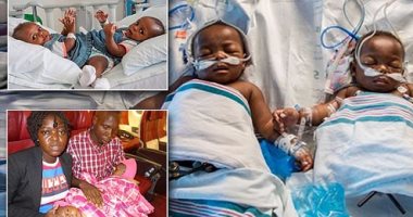 بالصور.. خضوع توأم ملتصق من الحوض لعملية فصل استغرقت 18 ساعة