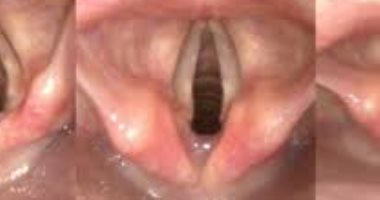 تعرف على أهم علاجات بحة الصوت.. خل التفاح وغرغرة الماء بالملح أهمها