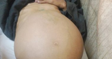 مواطن مريض بالكبد يطالب توفير مصاريف علاجه الشهرى 